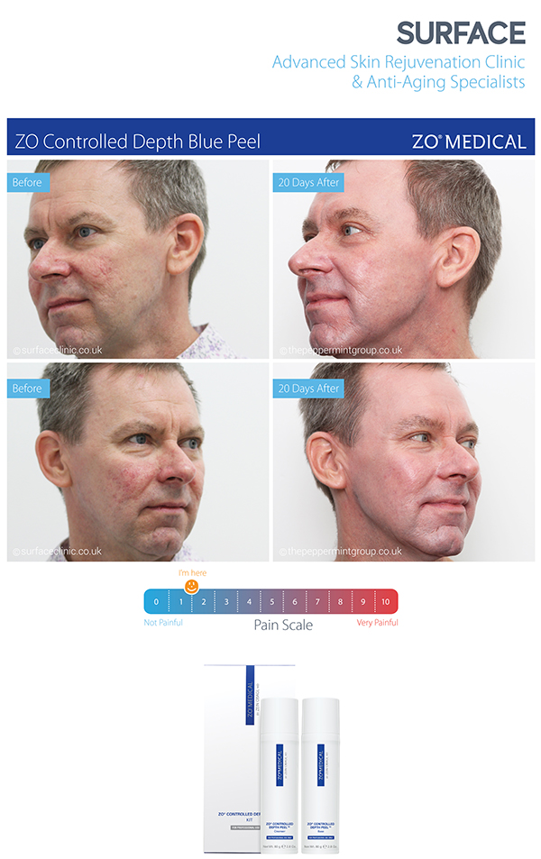 Case Study: ZO Controlled Depth Peel